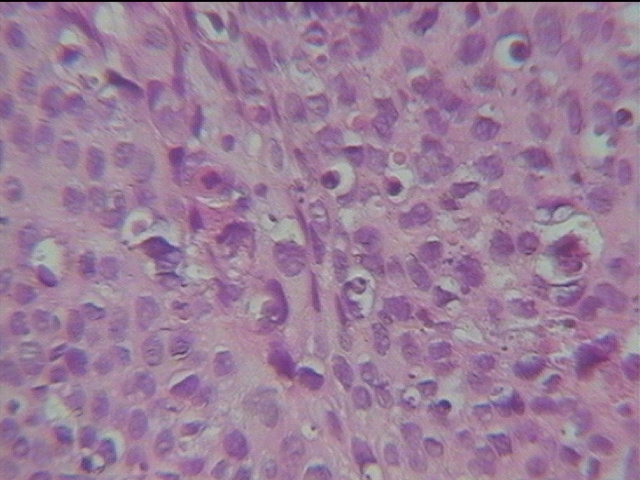 角结膜鳞状上皮细胞癌一例