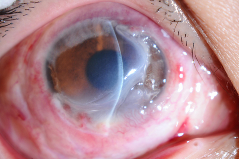 蚕食性角膜溃疡图片图片