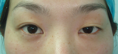手术前，双眼不对称。