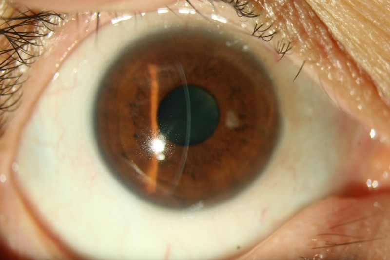 医药学论文-颞侧角膜透明切口白内障摘除术在青光眼滤过术后的临床