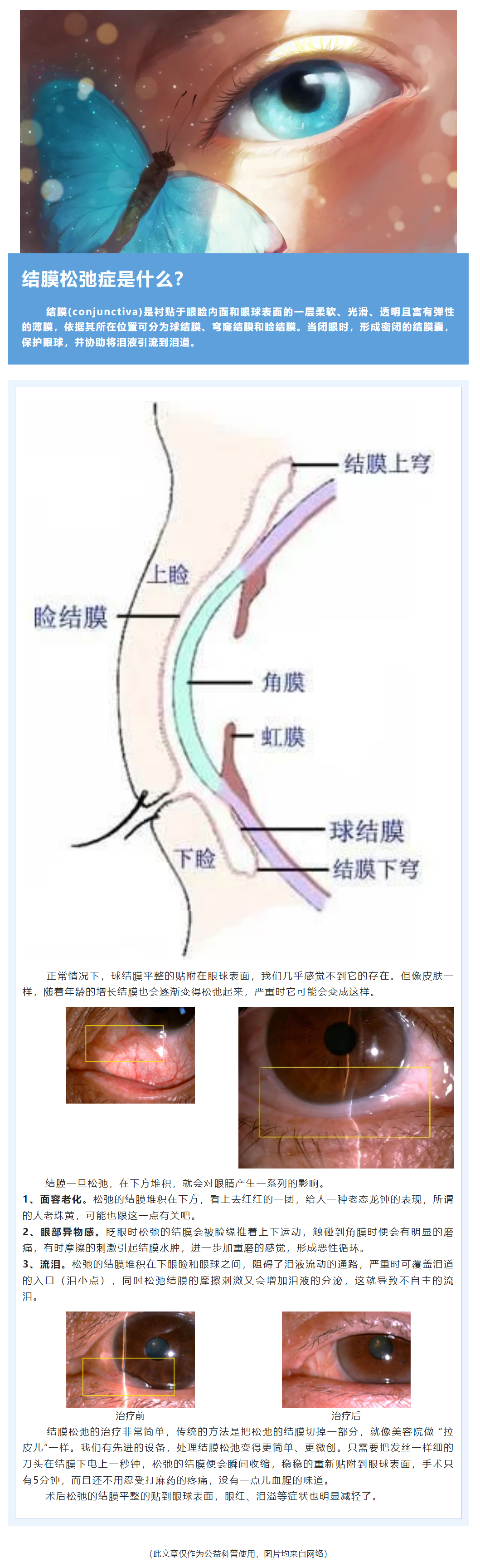 球结膜上隆起的黄色结节 -不速之客睑裂斑 - 知乎